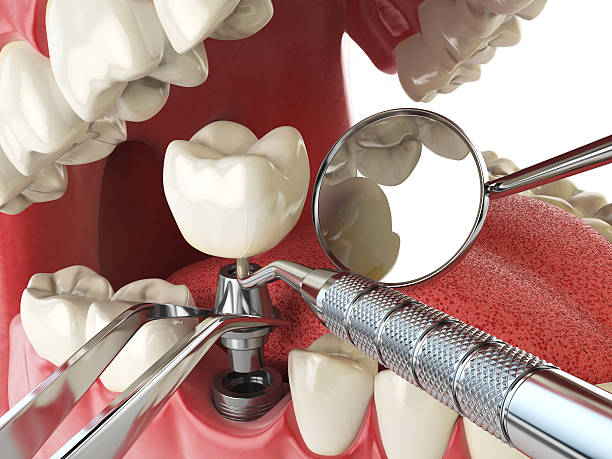 Best Emergency Root Canal Treatment in Odon, IN